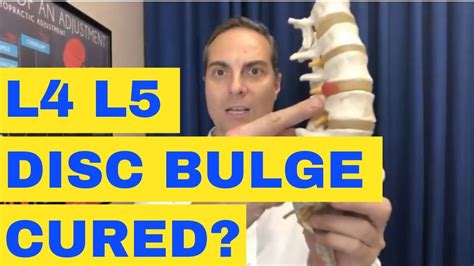 <b>Bulging</b> <b>disc</b> in this region applies pressure on lower body spinal nerve roots. . Is l4l5 disc bulge curable